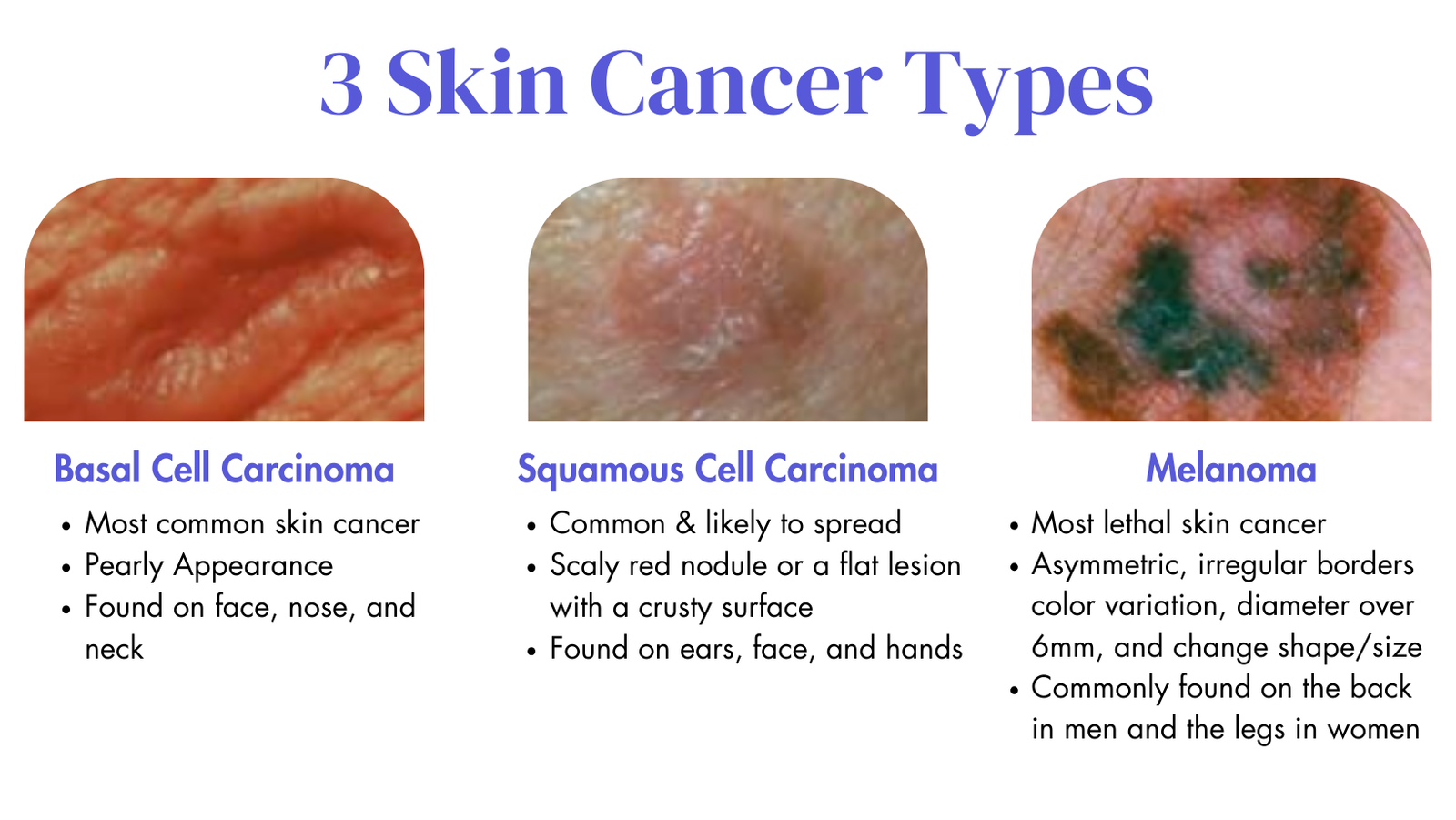 3 Skin Cancer Types