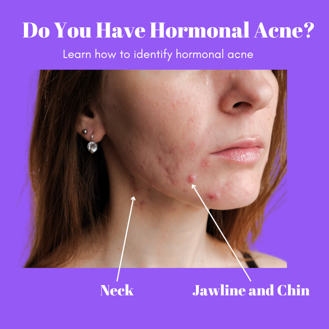 hormonal acne areas