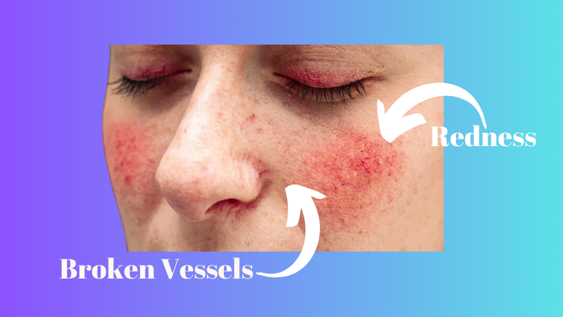 rosacea treatments and causes
