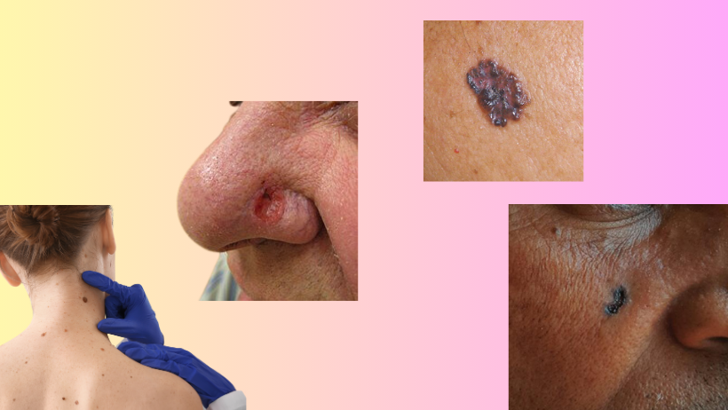 skin cancer types