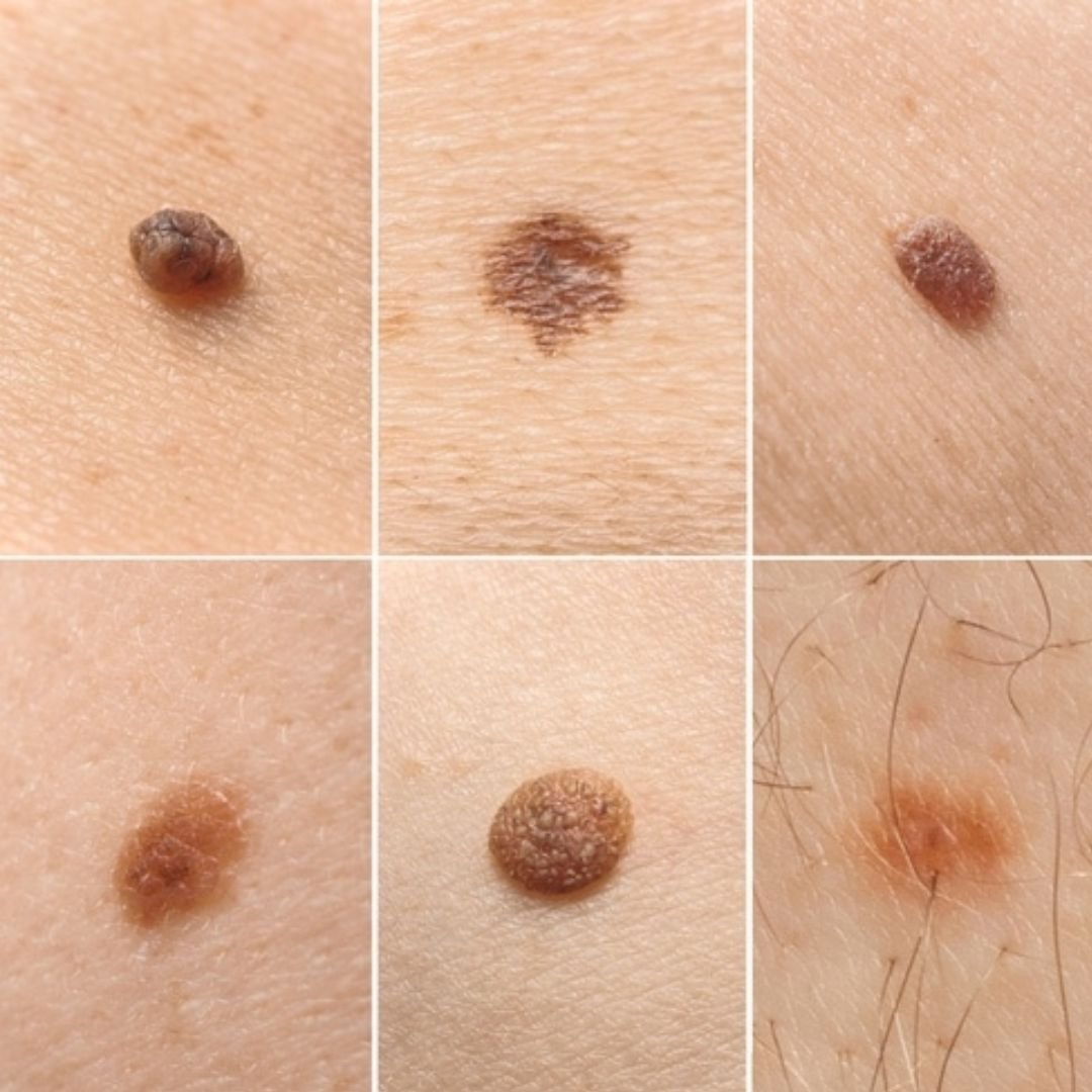 Types of intradermal nevi