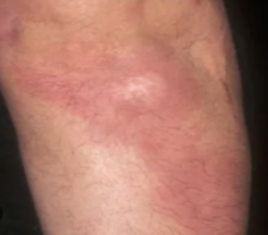 arm-after