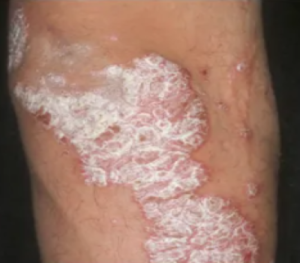 arm-before