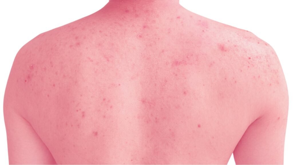 backacne treatments