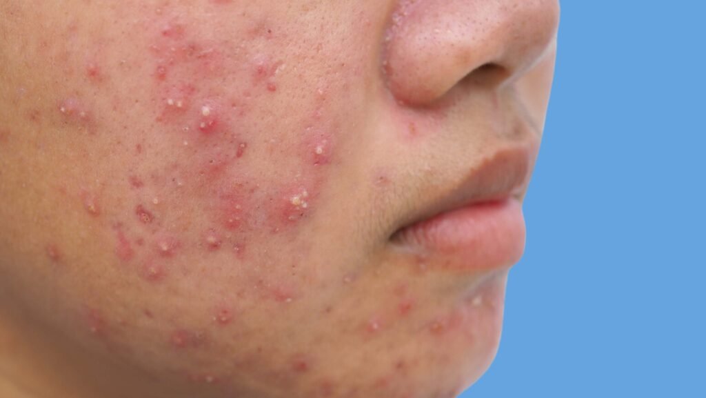 hormonal acne