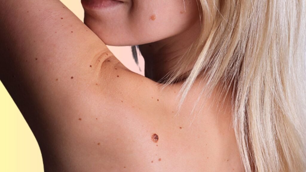 intradermal pigmented nevus