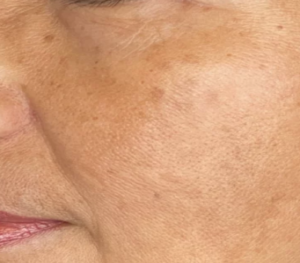 melasma after