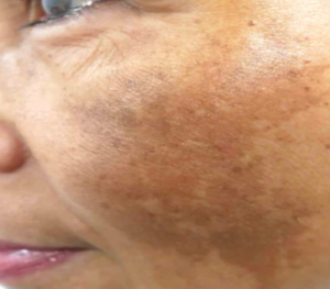 melasma before