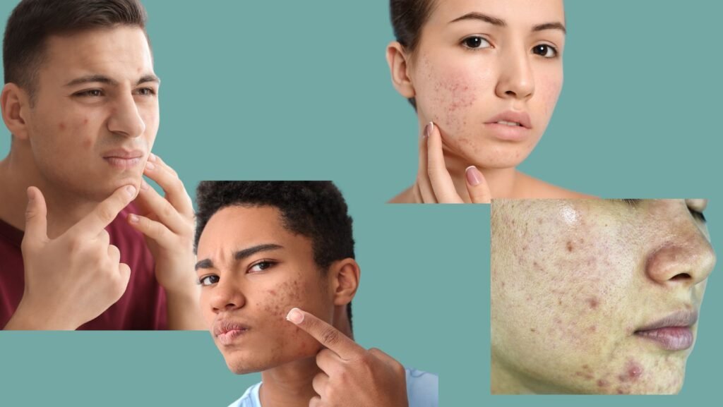 treating acne