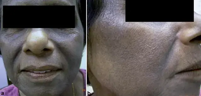 Pigmented Contact Dermatitis_result