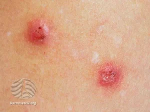 Prurigo Nodularis 2