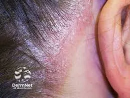 Scalp Psoriasis