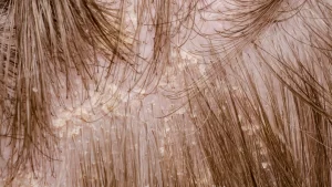 Seborrheic Dermatitis 2