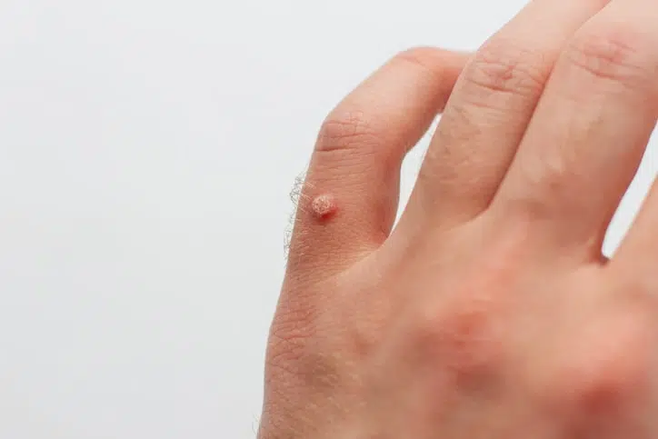 wart 4