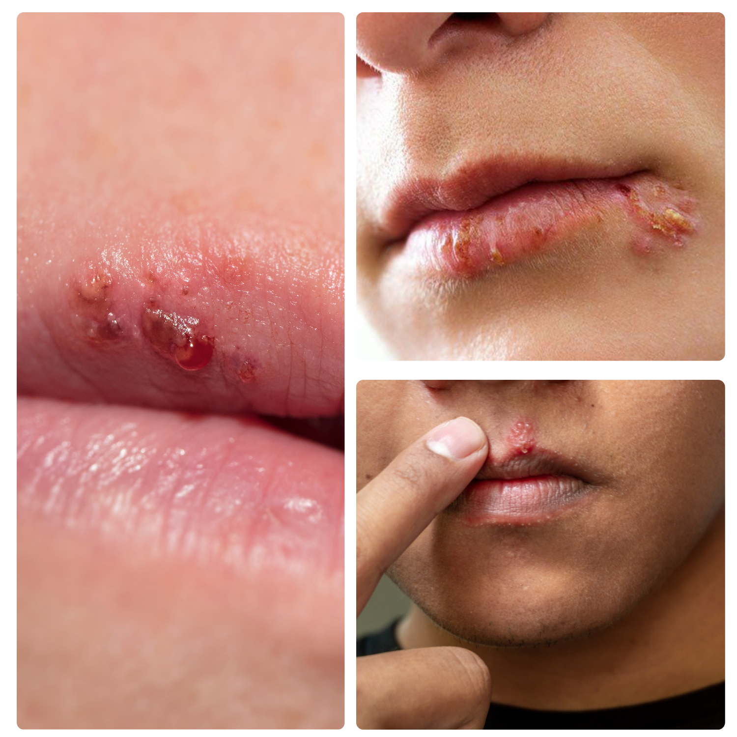 cold sore treatment