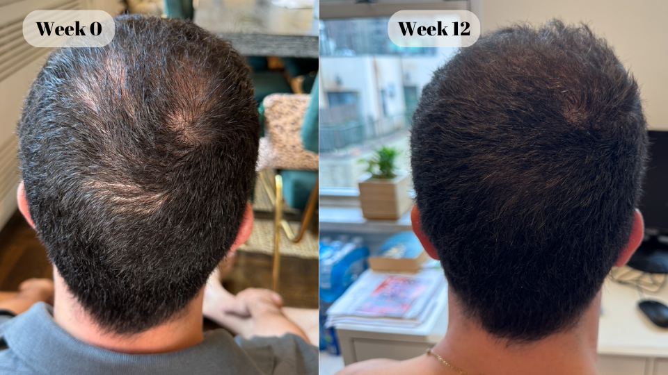 dutasteride before and after (2)
