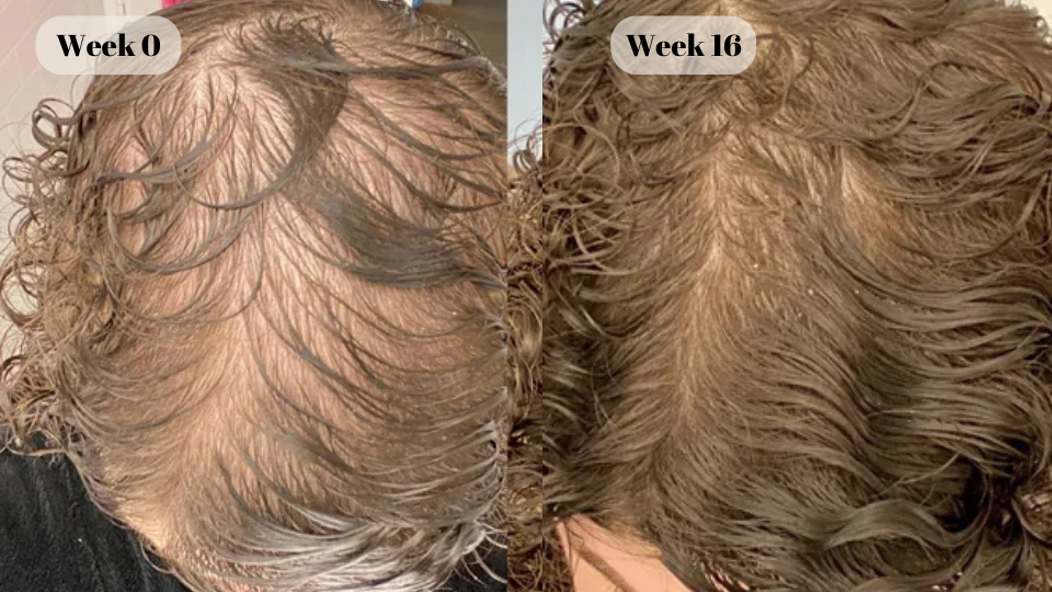 dutasteride before and after (4)