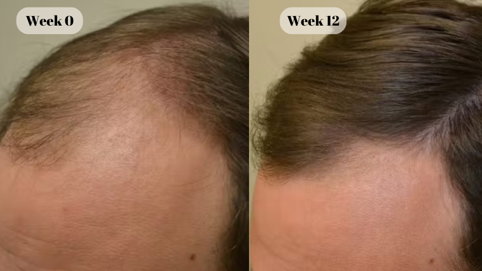 finasteride before and after (3)
