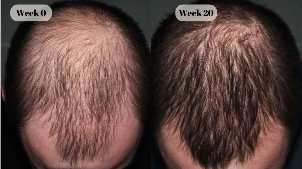 finasteride before and after (5)