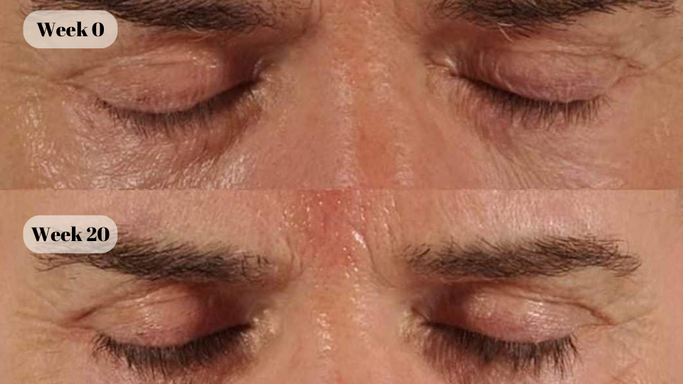 latisse before and after