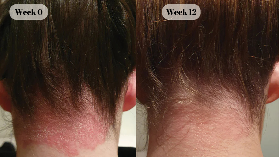 psoriasis before and after (4)