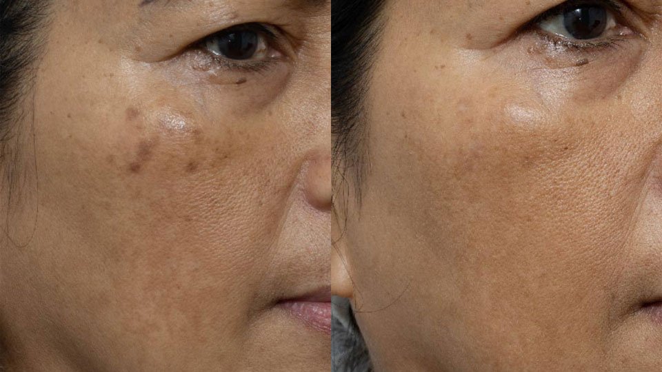 Melasma-Before-After-1