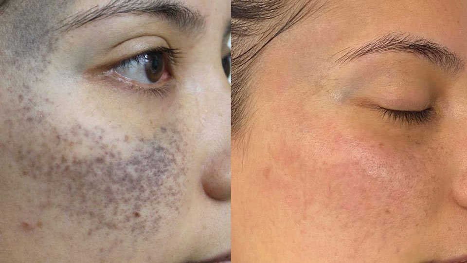 Melasma-Before-After-2