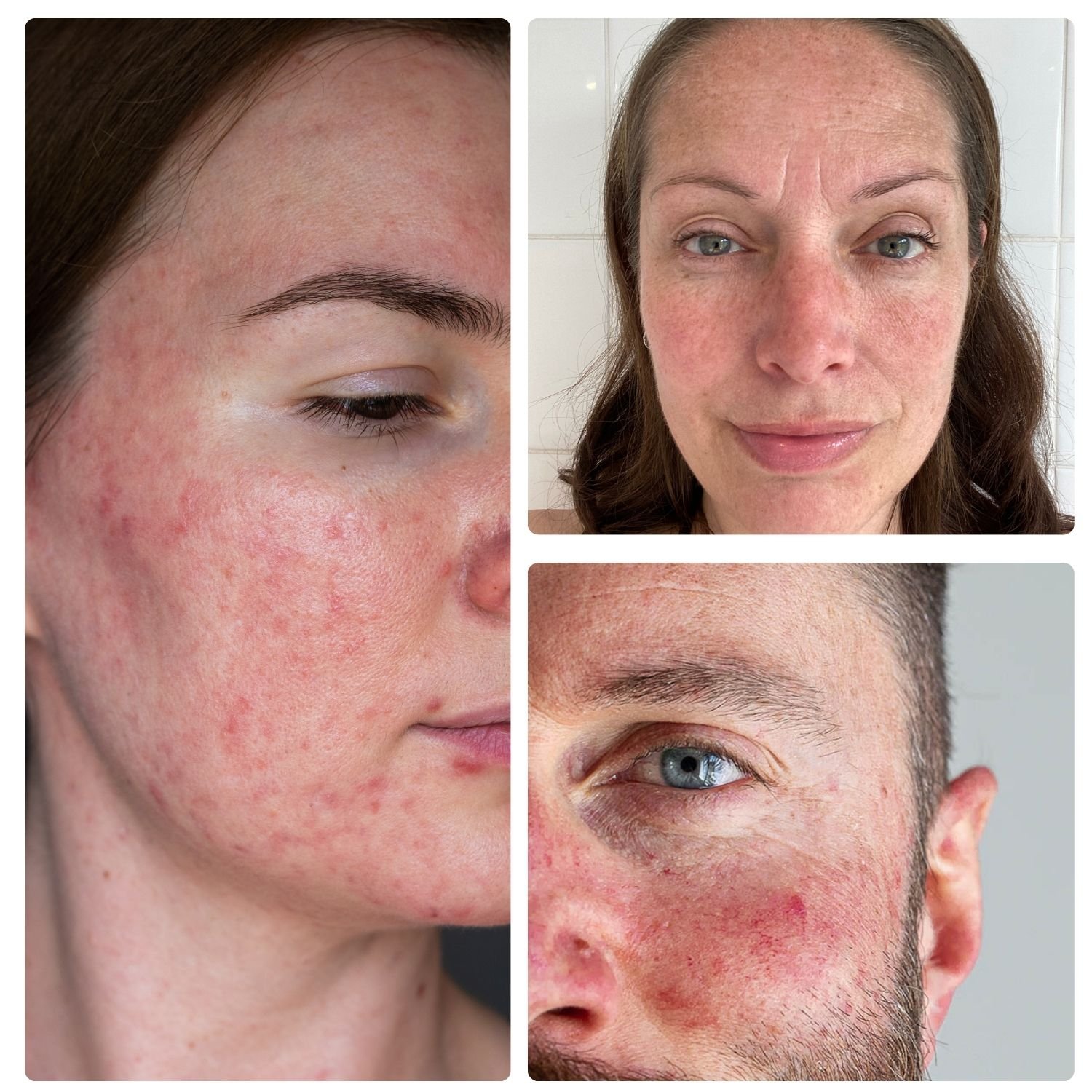 Rosacea treatment