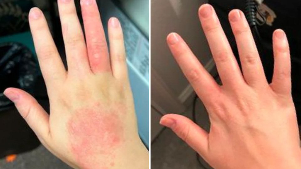 eczema-before-after-1