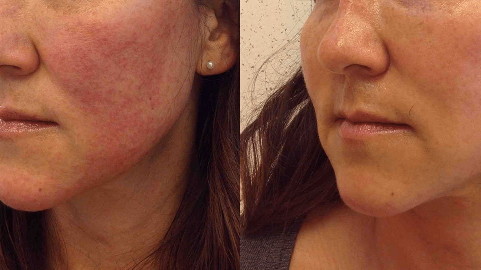 rosacea-after-before-1