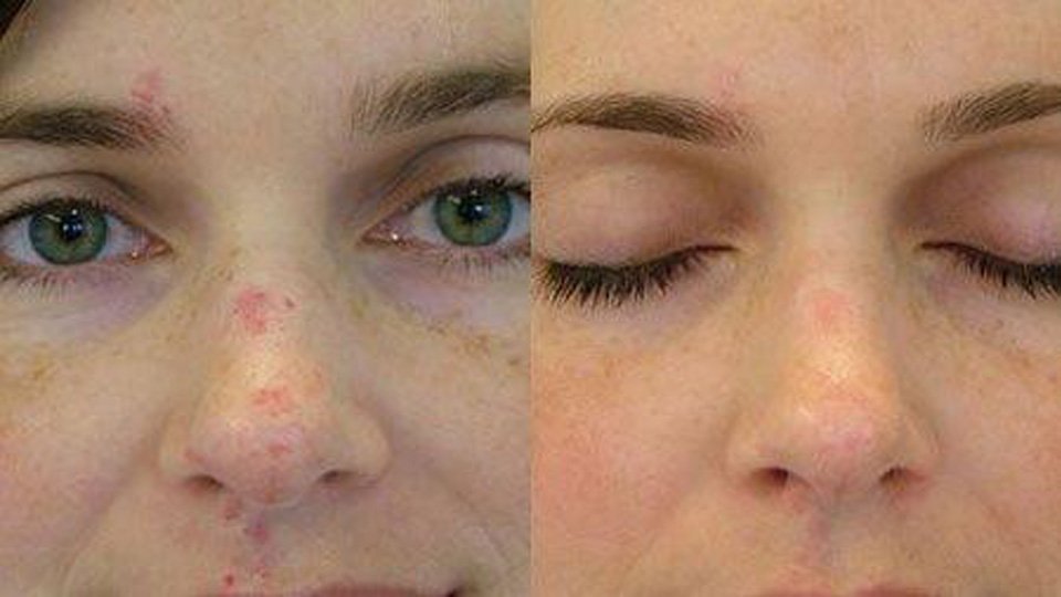 rosacea-after-before-3