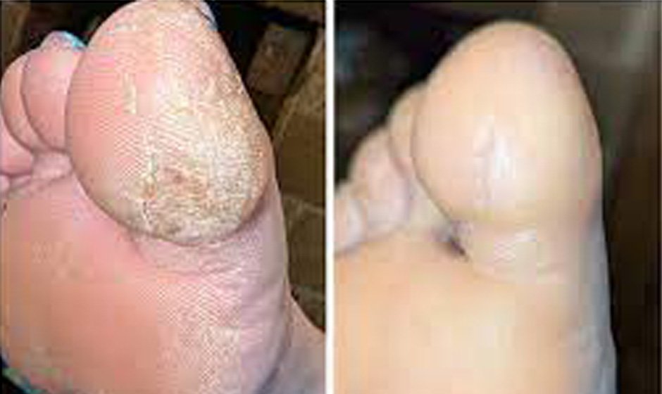 athelte-before-after5