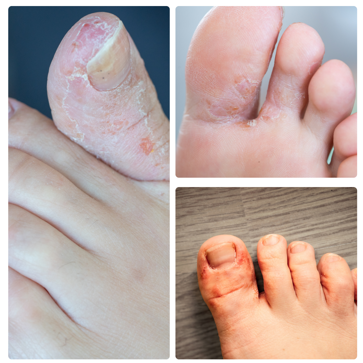 athletes foot treatment
