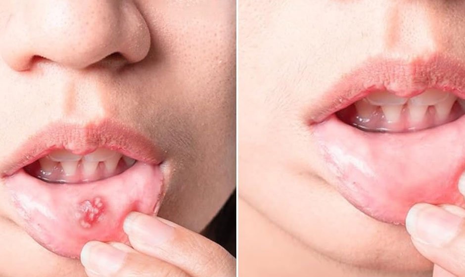 cold-sore-before-after4