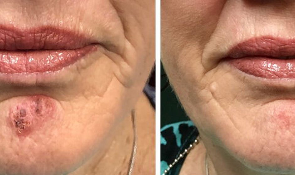 cold-sore-before-after5