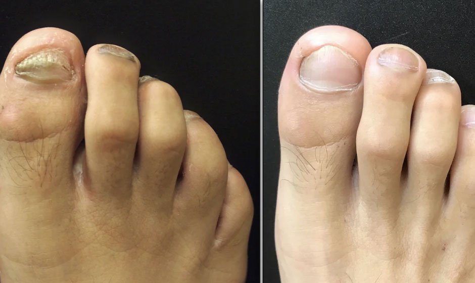 footr-before-after-2