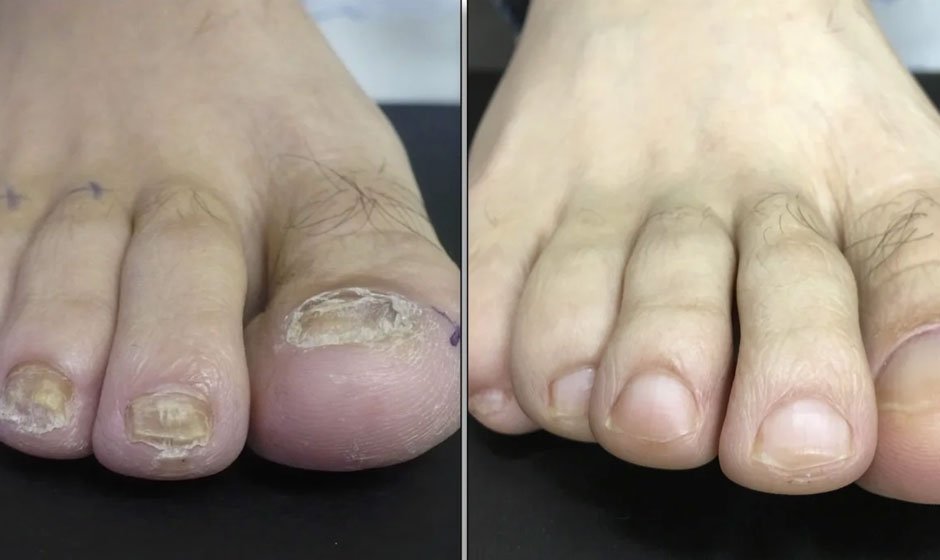 nail-before-after2
