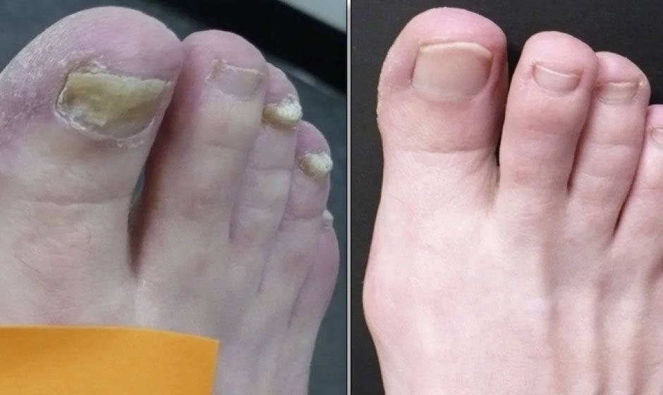 nail-before-after3